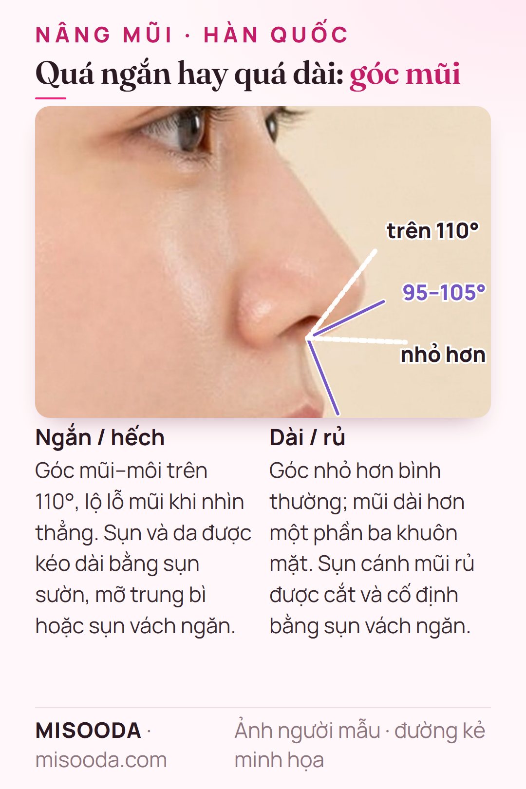 Chỉnh mũi ngắn và dài: góc mũi–môi lý tưởng 95–105°, trên 110° trông hếch; mũi khoảng một phần ba mặt; sụn sườn, sụn vách ngăn hoặc mỡ trung bì