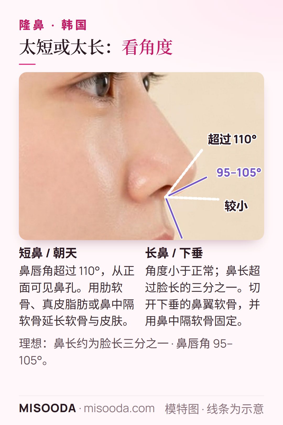 韩国 短鼻与长鼻矫正:理想鼻唇角 95–105°,超过 110° 显得朝天;鼻长约为脸长三分之一;使用肋软骨、鼻中隔软骨或真皮脂肪