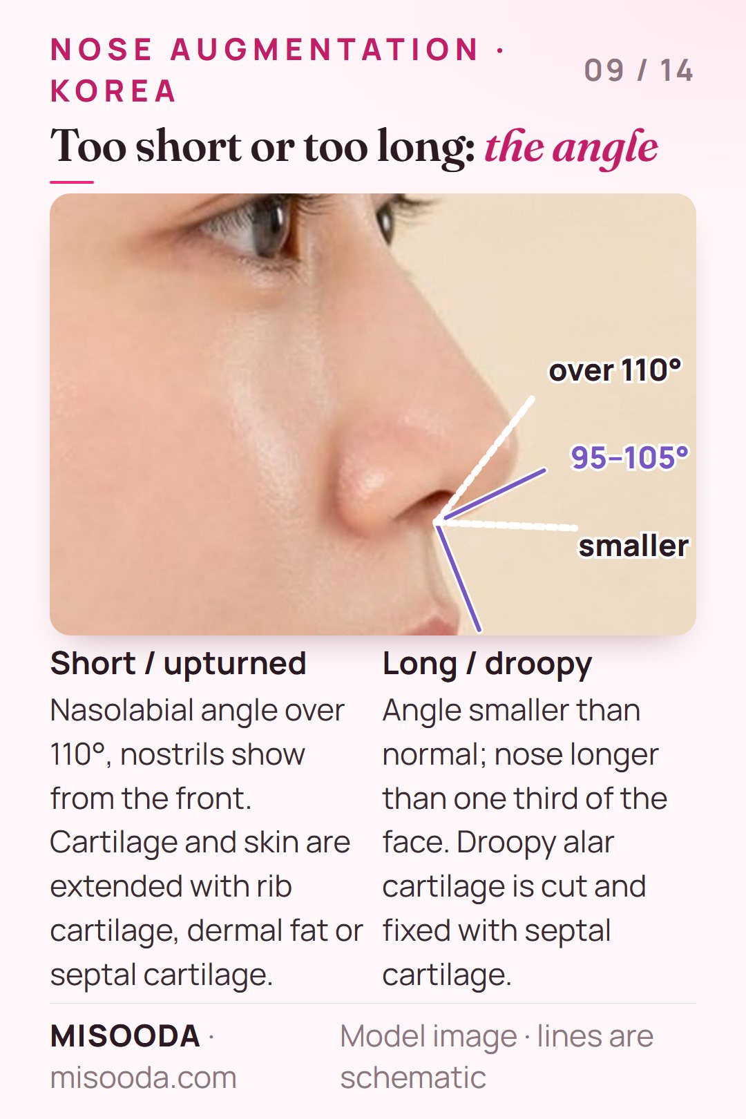 Short vs long nose correction: ideal nasolabial angle 95–105°, over 110° looks upturned; nose about one third of face length; rib, septal cartilage or dermal fat
