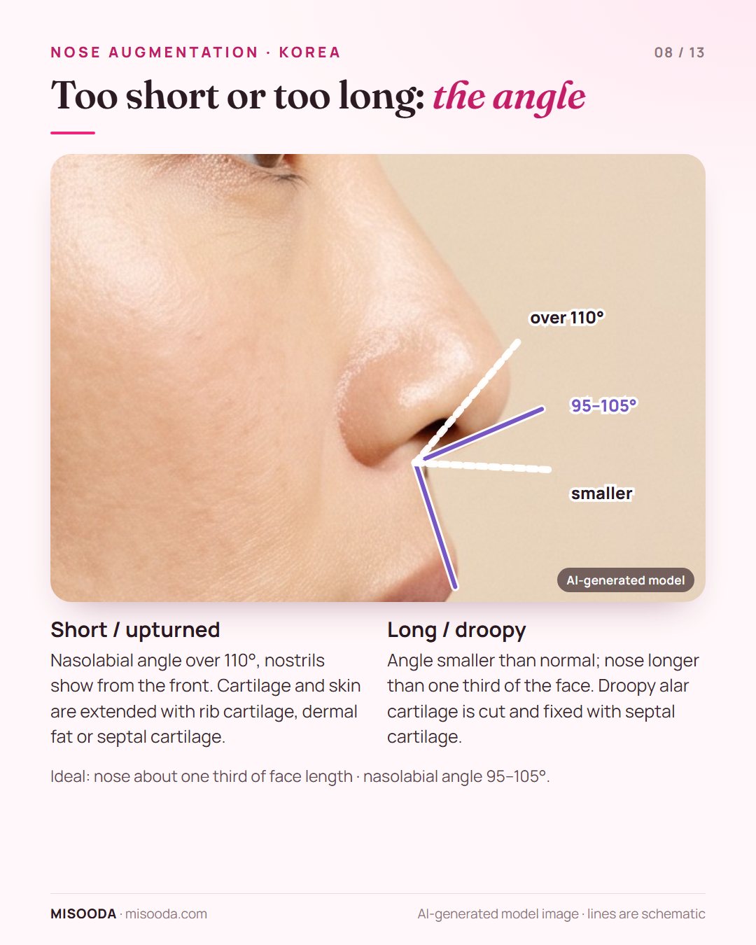 Short vs long nose correction: ideal nasolabial angle 95–105°, over 110° looks upturned; nose about one third of face length; rib, septal cartilage or dermal fat