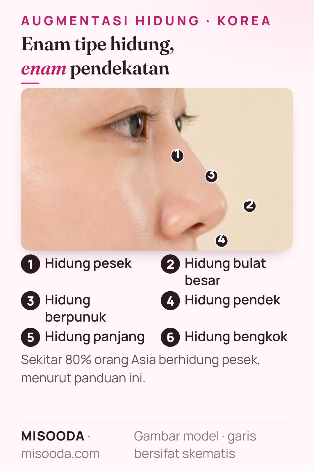Enam tipe hidung untuk operasi hidung di Korea: pesek, bulat besar, berpunuk, pendek, panjang, dan bengkok, masing-masing dengan pendekatan koreksinya