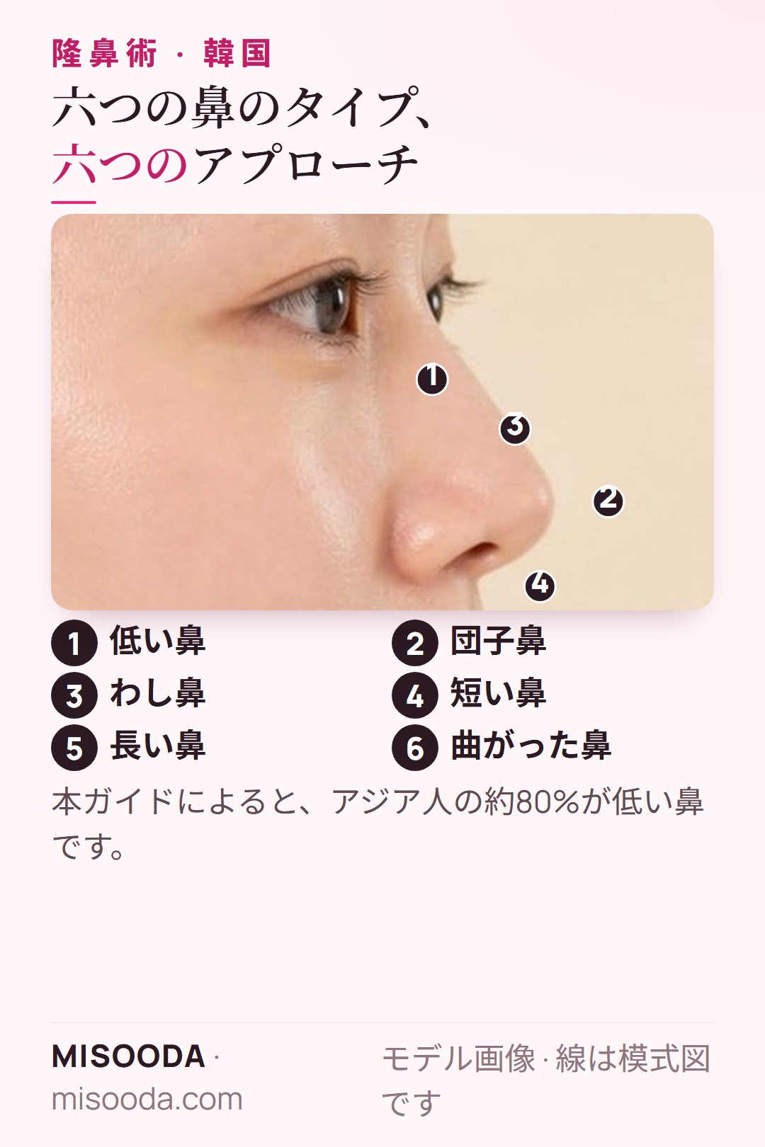 韓国 隆鼻術の六つの鼻のタイプ:低い鼻、団子鼻、わし鼻、短い鼻、長い鼻、曲がった鼻と、それぞれの修正方法