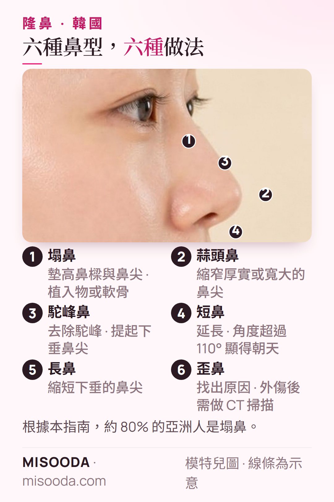 韓國 隆鼻的六種鼻型:塌鼻、蒜頭鼻、駝峰鼻、短鼻、長鼻與歪鼻,各有不同的矯正做法