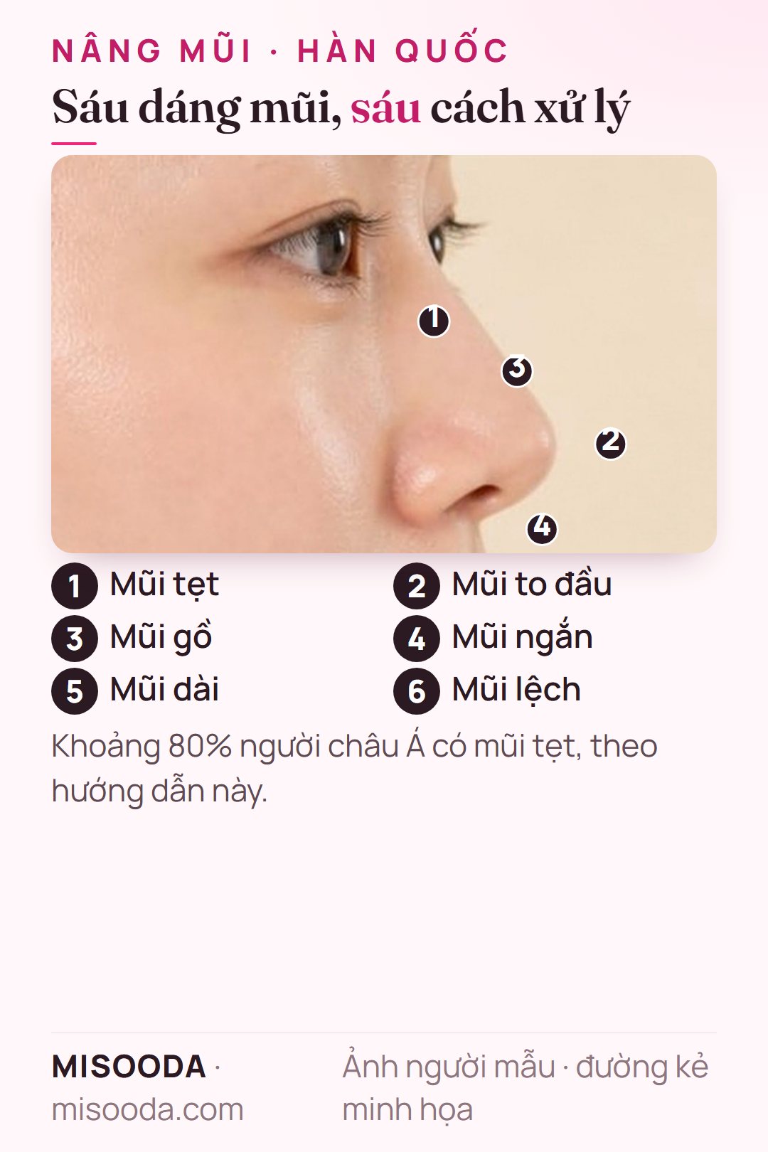 Sáu dáng mũi khi nâng mũi Hàn Quốc: mũi tẹt, to đầu, gồ, ngắn, dài và lệch, mỗi dáng có cách chỉnh riêng