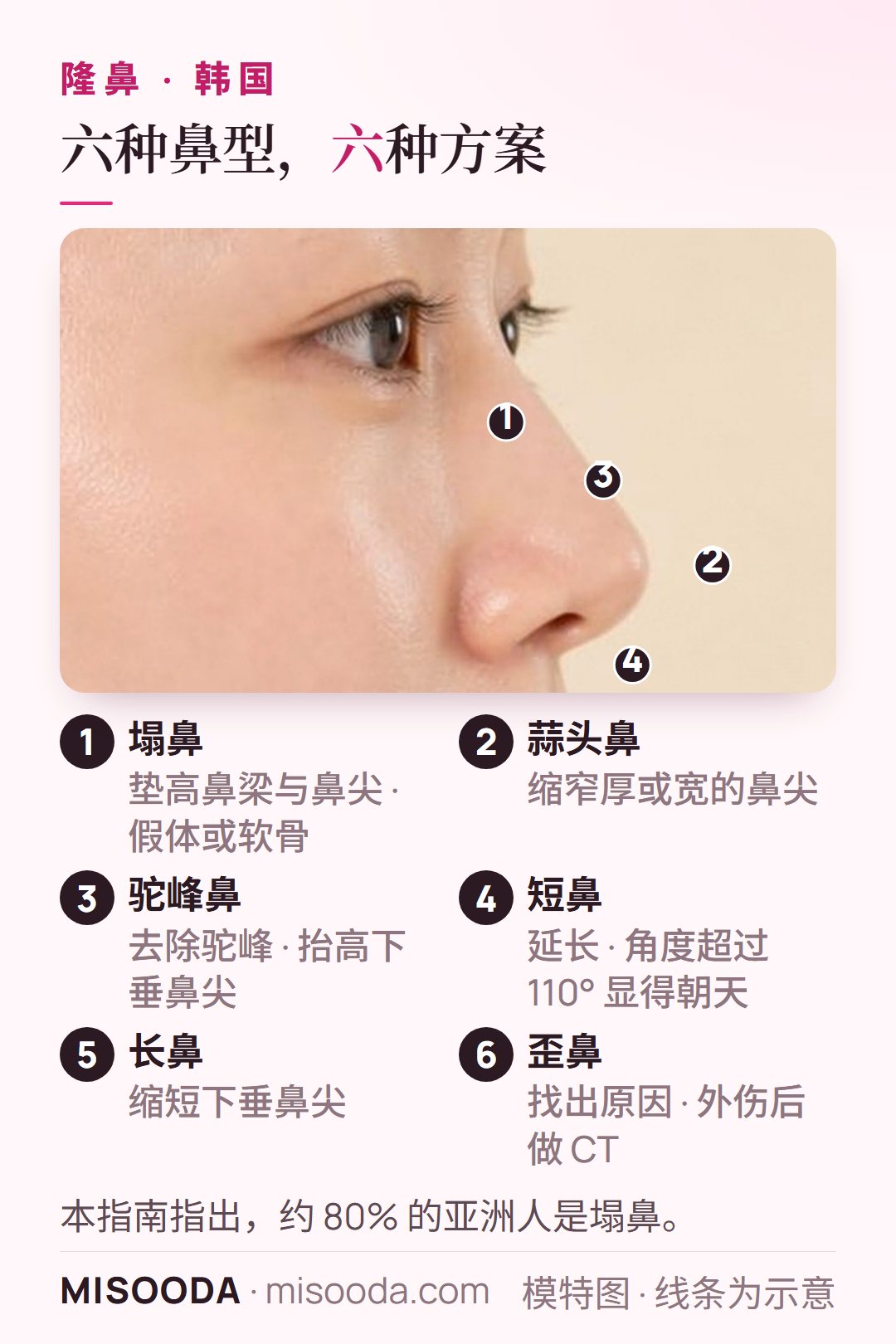 韩国 隆鼻的六种鼻型:塌鼻、蒜头鼻、驼峰鼻、短鼻、长鼻与歪鼻,各有不同的矫正方案