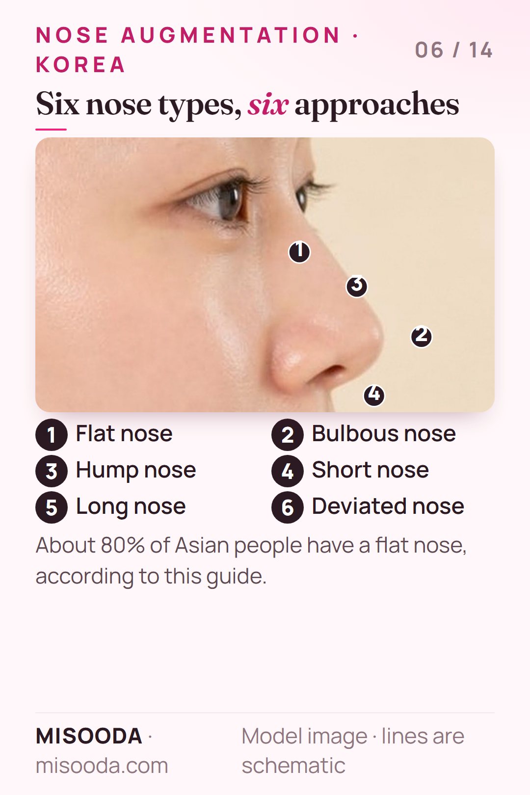 Six nose types for nose augmentation in Korea: flat, bulbous, hump, short, long and deviated nose, each with its own correction approach