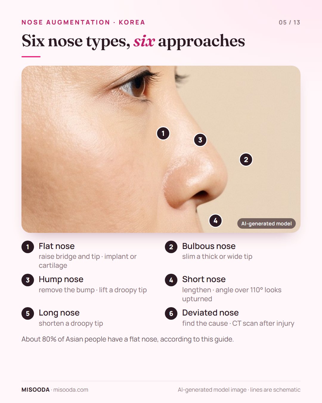 Six nose types for nose augmentation in Korea: flat, bulbous, hump, short, long and deviated nose, each with its own correction approach