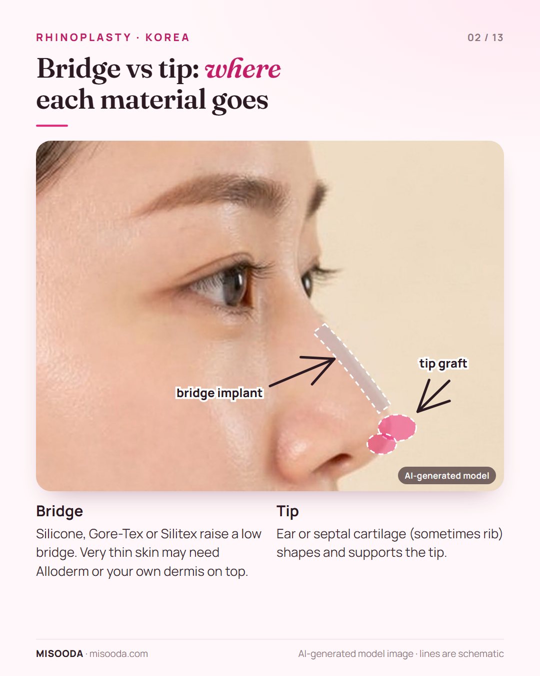 Rhinoplasty bridge implant along the nasal dorsum and cartilage tip graft shown on a side profile