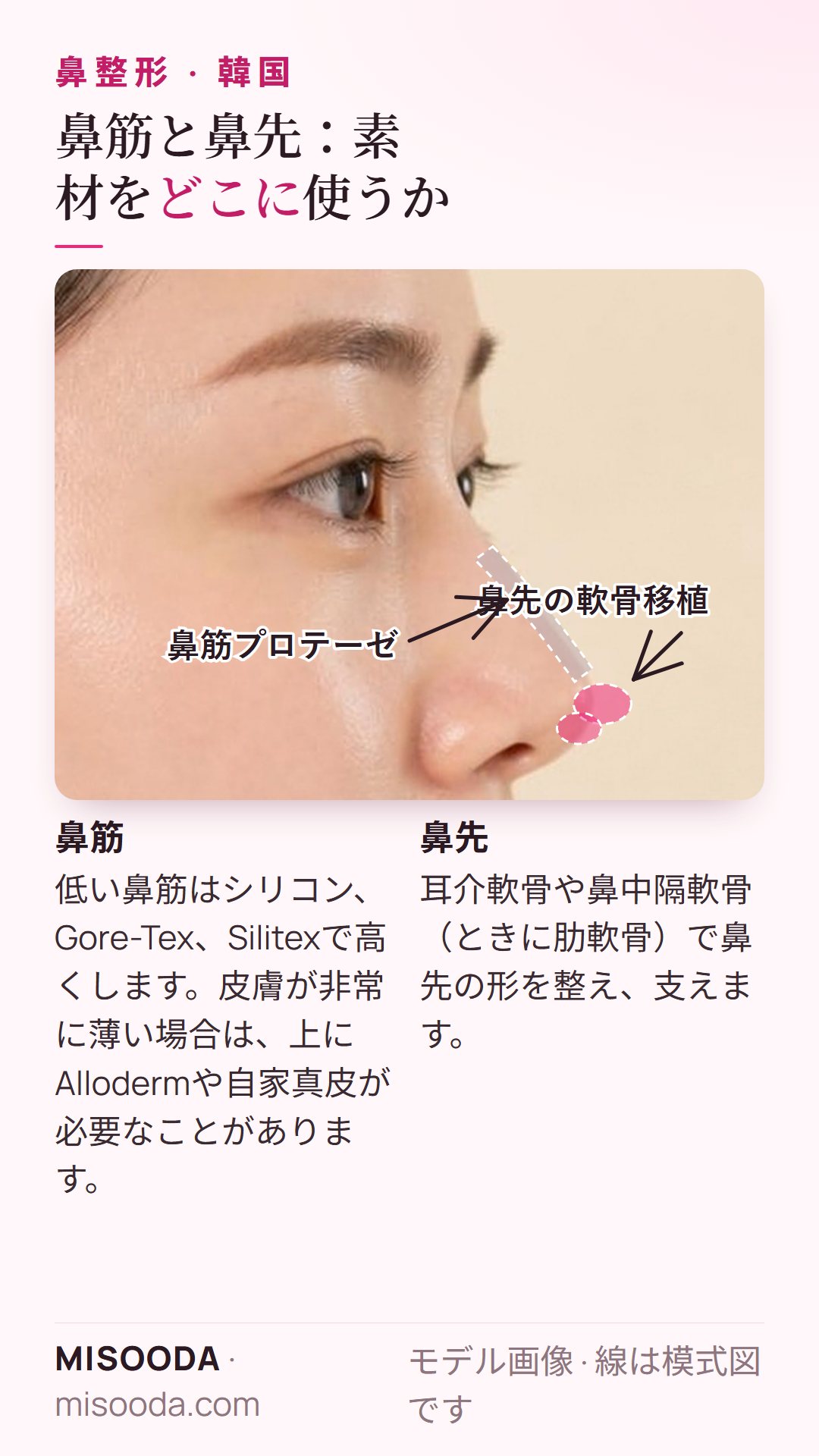 韓国 鼻整形の図解:鼻背に沿って入れる鼻筋プロテーゼと、鼻先に行う軟骨移植の位置を、横顔の側面図で分かりやすく示した図解イラスト