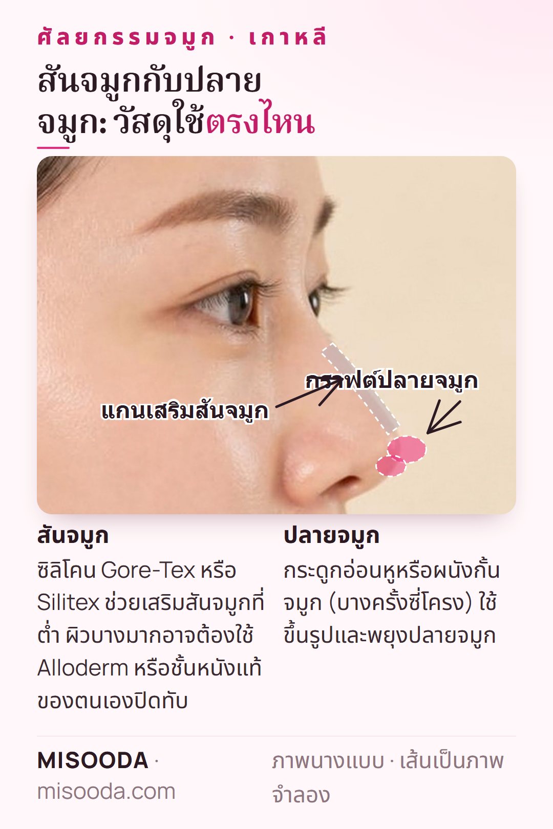 ศัลยกรรมจมูก เกาหลี: แกนเสริมสันจมูกตามแนว dorsum และกราฟต์กระดูกอ่อนที่ปลายจมูก แสดงในมุมด้านข้าง