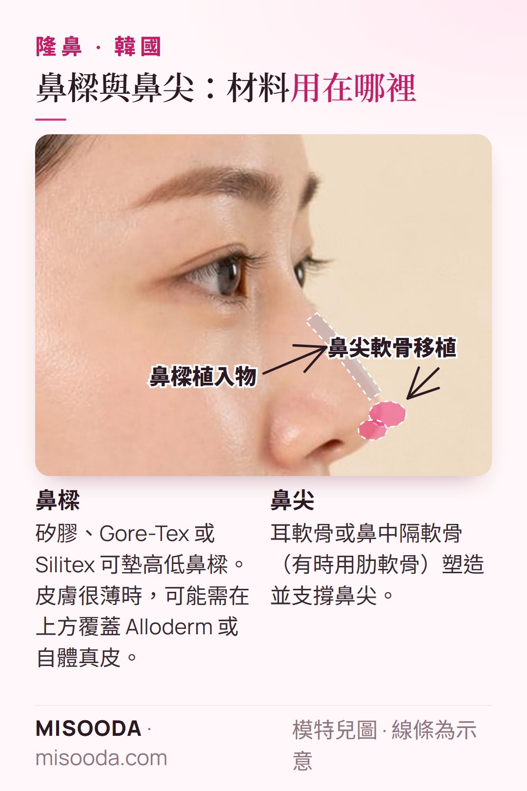 韓國 隆鼻示意圖:沿鼻背放置的鼻樑植入物,以及鼻尖軟骨移植,在側臉上展示兩者的位置與作用,幫助您在諮詢前理解兩種手術方式的差異