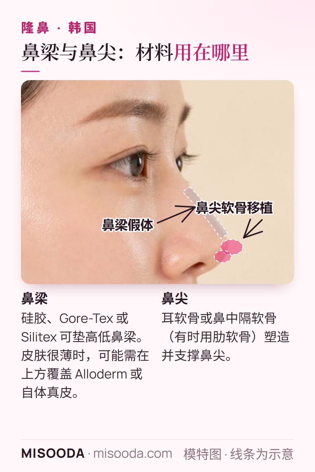 韩国 隆鼻示意图:沿鼻背放置的鼻梁假体,以及鼻尖软骨移植,在侧脸上展示两者的位置与作用,帮助您在咨询前理解两种手术方式的差异