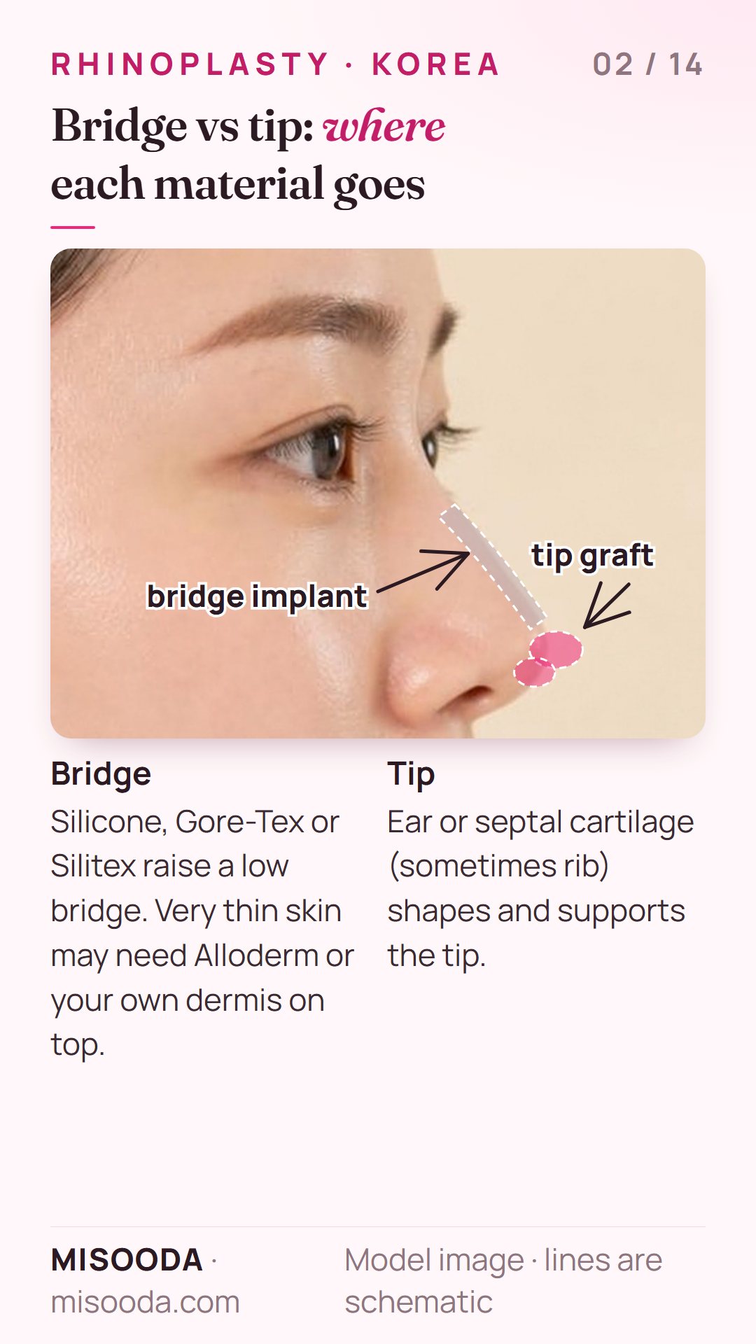 Rhinoplasty bridge implant along the nasal dorsum and cartilage tip graft shown on a side profile