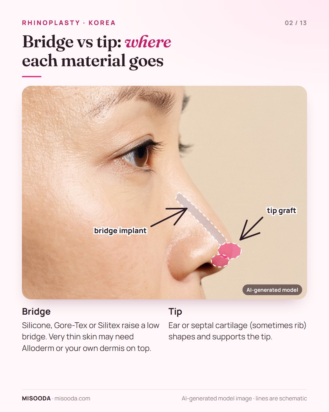 Rhinoplasty bridge implant along the nasal dorsum and cartilage tip graft shown on a side profile