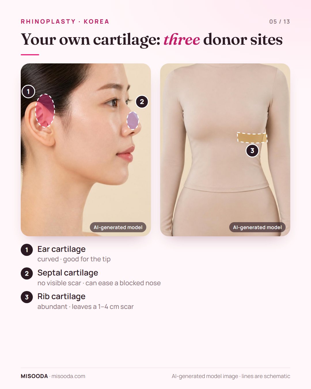 Autologous cartilage for rhinoplasty: ear cartilage, septal cartilage and rib cartilage donor sites, rib leaving a 1–4 cm scar