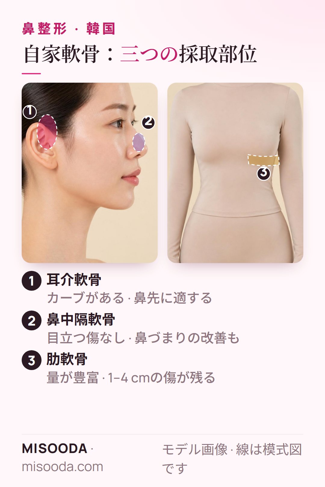韓国 鼻整形に使う自家軟骨:耳介軟骨・鼻中隔軟骨・肋軟骨の採取部位。肋軟骨は採取量が多い一方、1–4 cmの傷が残るという違いを示した図