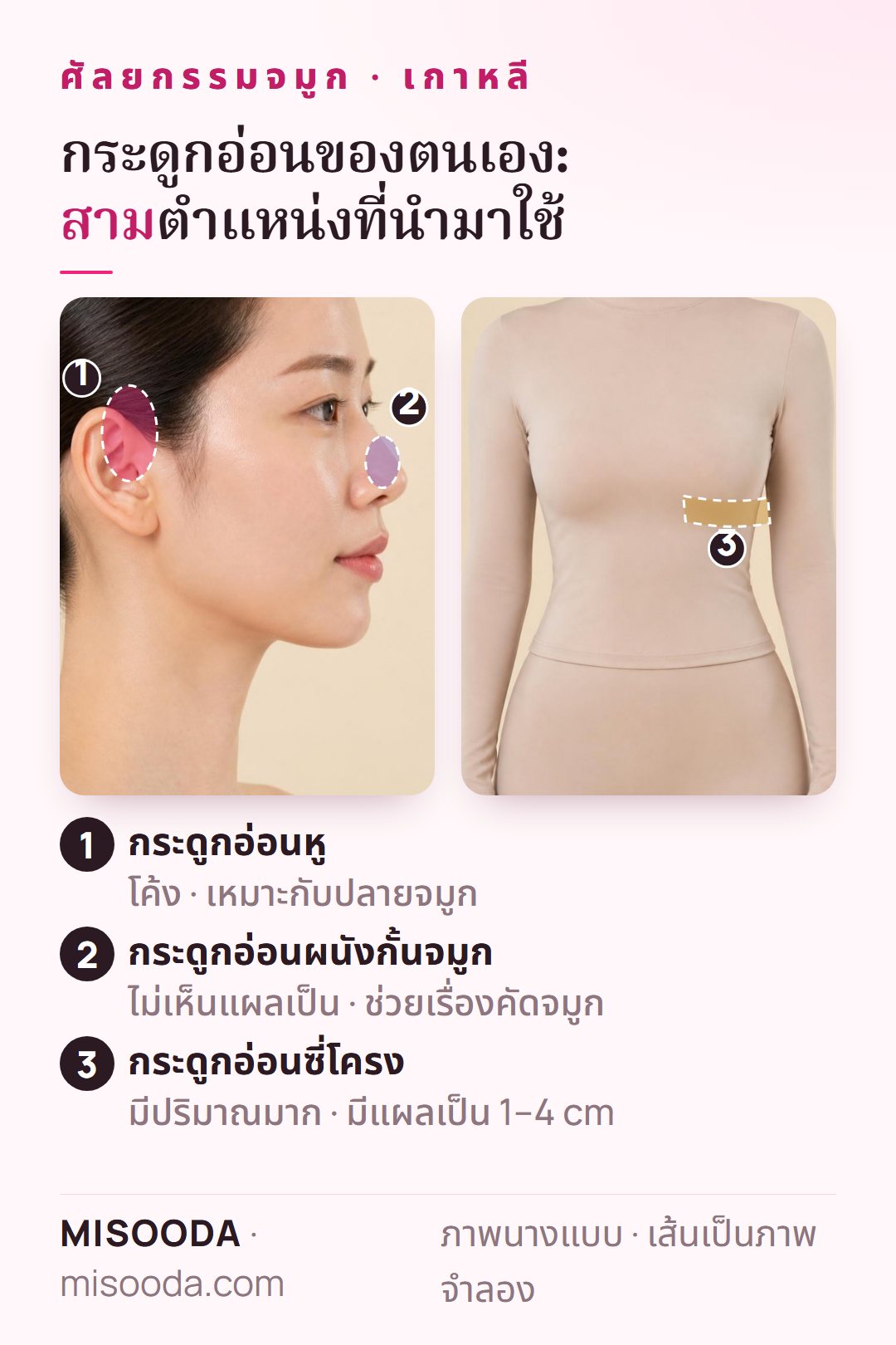 กระดูกอ่อนของตนเองสำหรับศัลยกรรมจมูก เกาหลี: ตำแหน่งกระดูกอ่อนหู ผนังกั้นจมูก และซี่โครง โดยซี่โครงมีแผลเป็น 1–4 cm