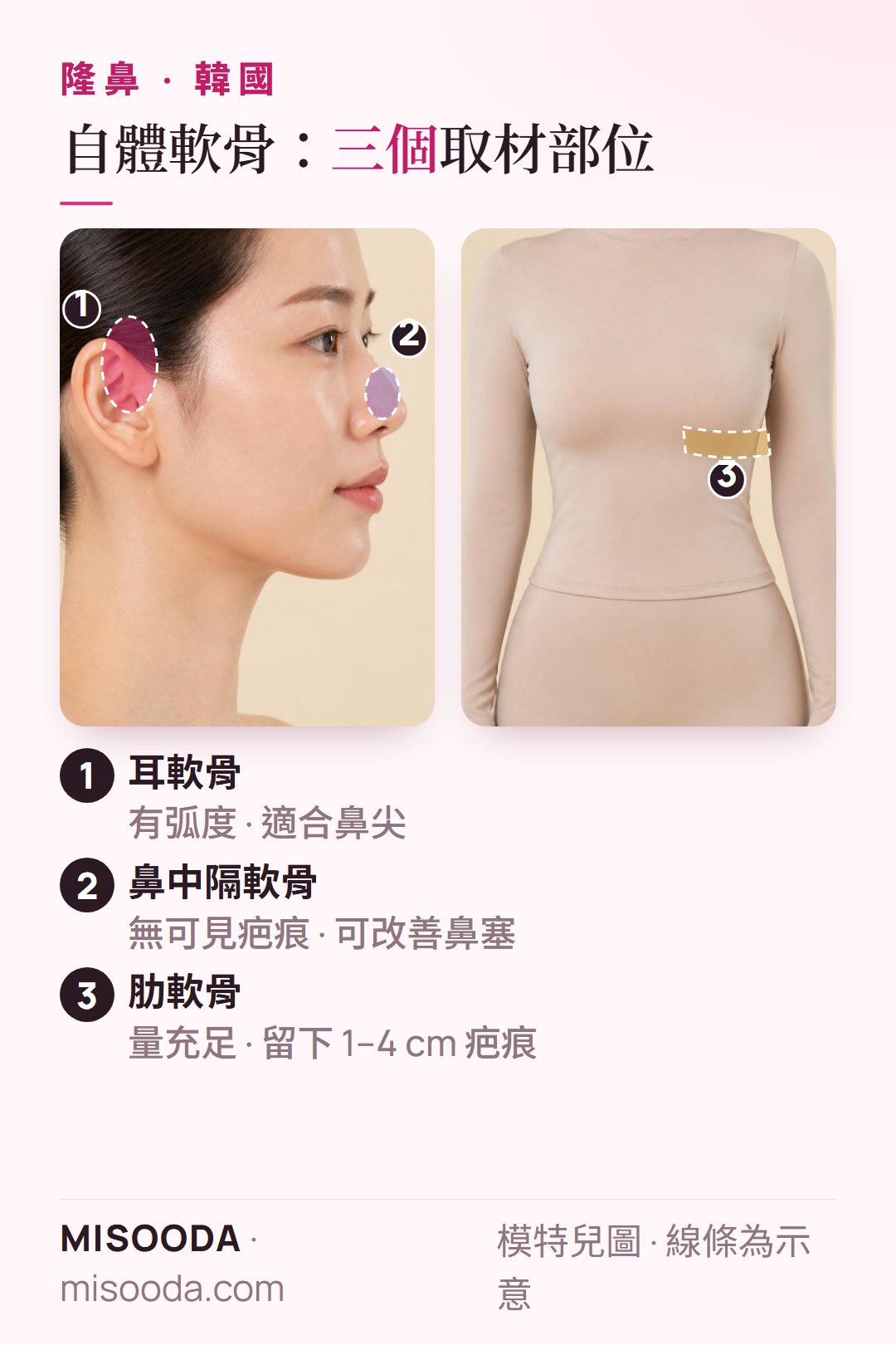 韓國 隆鼻使用的自體軟骨:耳軟骨、鼻中隔軟骨與肋軟骨三個取材部位的示意圖,其中肋軟骨取材量多,但會留下 1–4 cm 疤痕,各有取捨