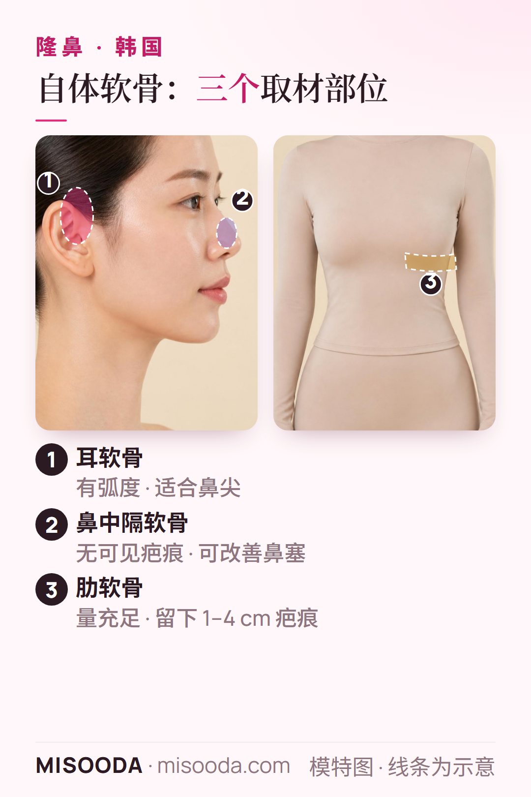 韩国 隆鼻使用的自体软骨:耳软骨、鼻中隔软骨与肋软骨三个取材部位的示意图,其中肋软骨取材量多,但会留下 1–4 cm 疤痕,各有取舍
