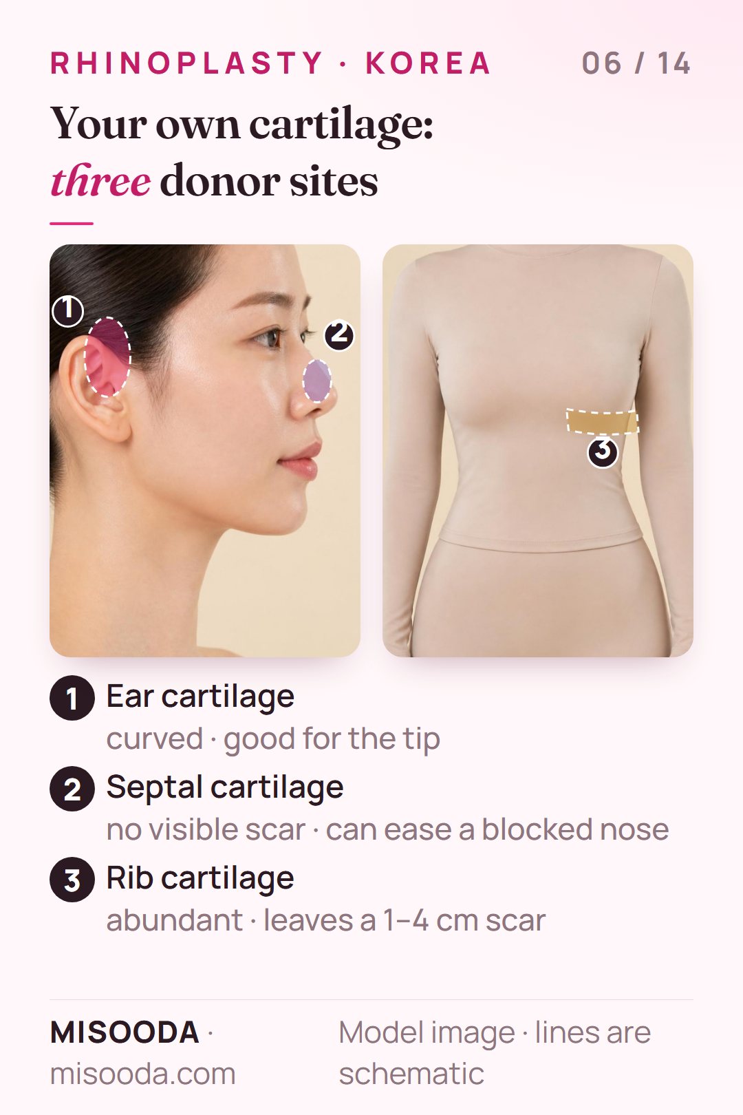 Autologous cartilage for rhinoplasty: ear cartilage, septal cartilage and rib cartilage donor sites, rib leaving a 1–4 cm scar