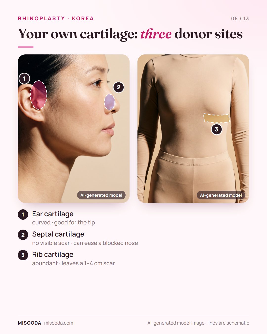 Autologous cartilage for rhinoplasty: ear cartilage, septal cartilage and rib cartilage donor sites, rib leaving a 1–4 cm scar