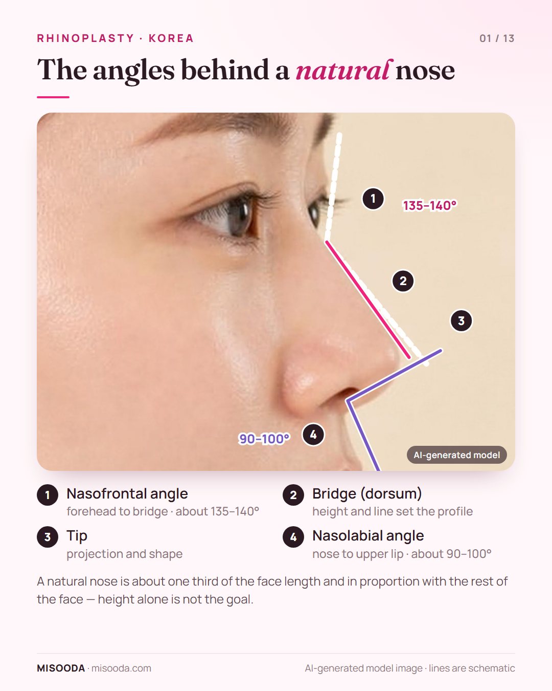 Ideal nose proportions for rhinoplasty in Korea: nasofrontal angle about 135–140°, nasolabial angle about 90–100°, bridge and tip on a side profile