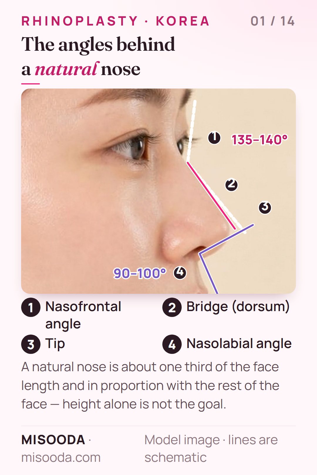 Ideal nose proportions for rhinoplasty in Korea: nasofrontal angle about 135–140°, nasolabial angle about 90–100°, bridge and tip on a side profile