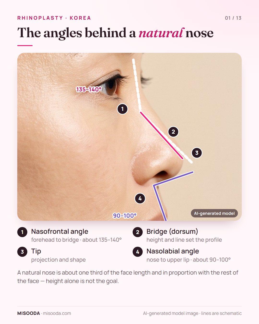 Ideal nose proportions for rhinoplasty in Korea: nasofrontal angle about 135–140°, nasolabial angle about 90–100°, bridge and tip on a side profile