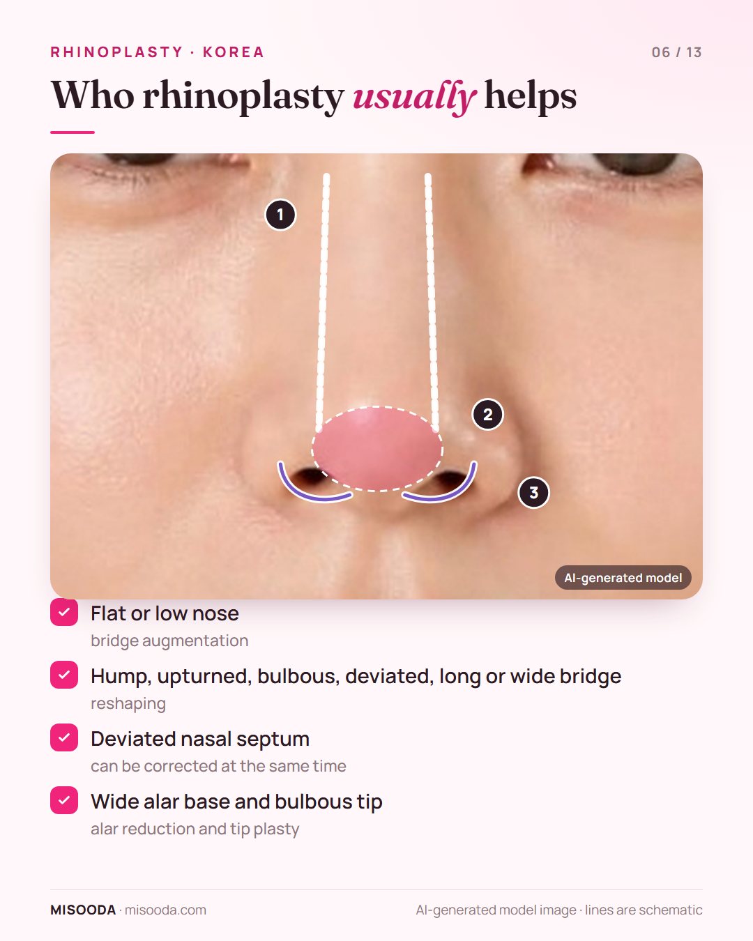 Rhinoplasty candidates: low nasal bridge, hump or bulbous tip, deviated septum, wide alar base, shown on a front view of the nose