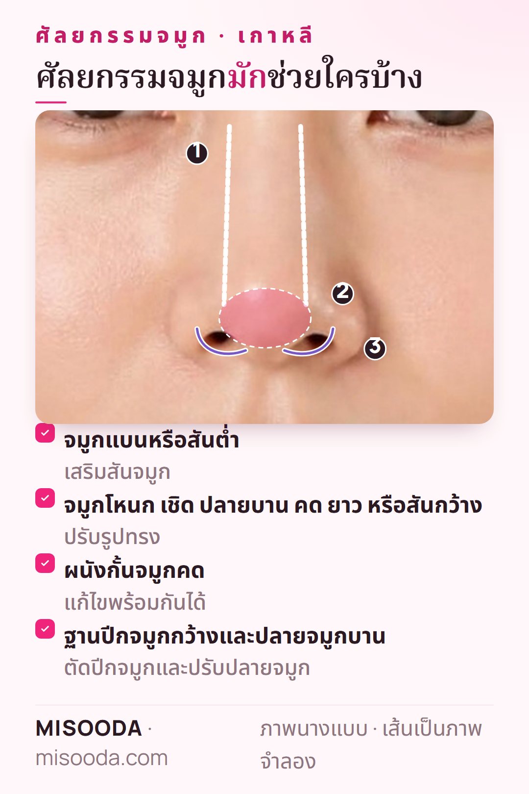 ผู้ที่เหมาะกับศัลยกรรมจมูก เกาหลี: สันจมูกต่ำ จมูกโหนกหรือปลายบาน ผนังกั้นจมูกคด ฐานปีกจมูกกว้าง แสดงจากด้านหน้า