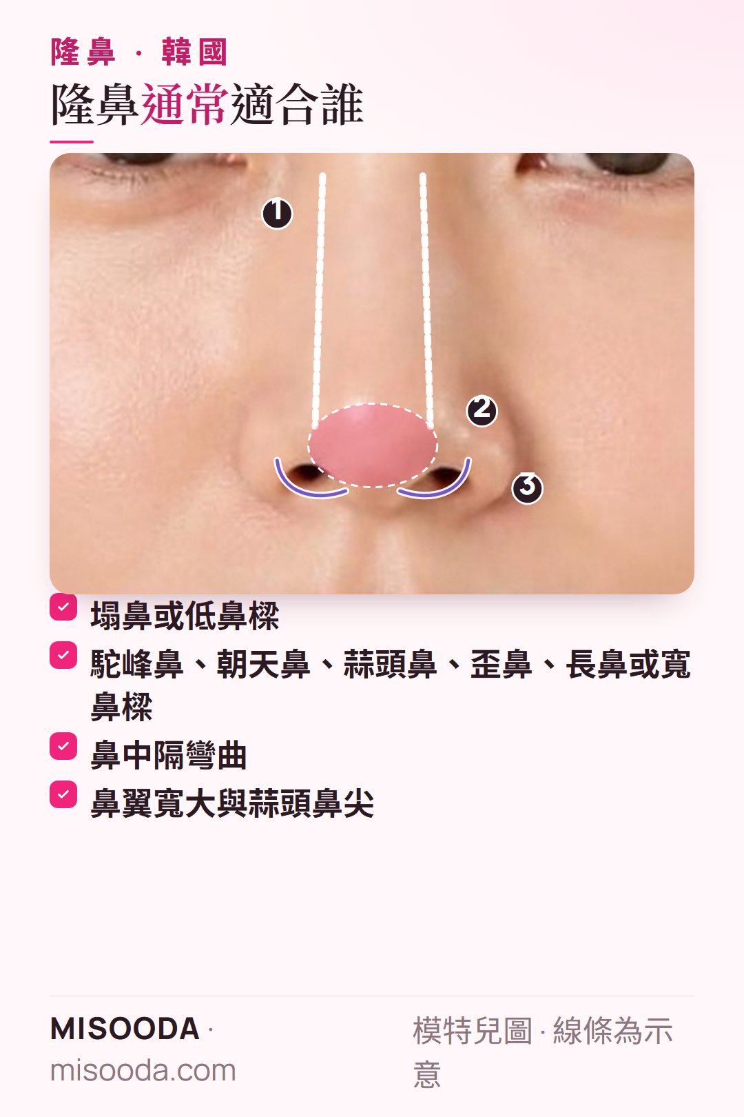 韓國 隆鼻適合哪些人:鼻樑低、駝峰鼻或蒜頭鼻、鼻中隔彎曲、鼻翼寬等常見情況,以鼻部正面示意圖呈現,方便對照自己的鼻型與需求