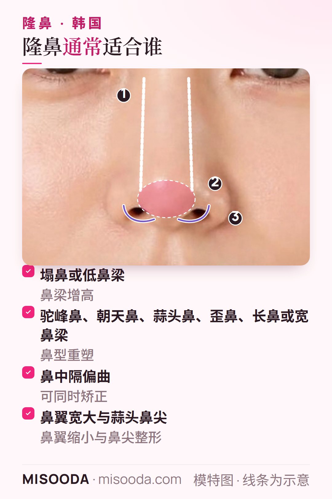 韩国 隆鼻适合哪些人:鼻梁低、驼峰鼻或蒜头鼻、鼻中隔偏曲、鼻翼宽等常见情况,以鼻部正面示意图呈现,方便对照自己的鼻型与需求