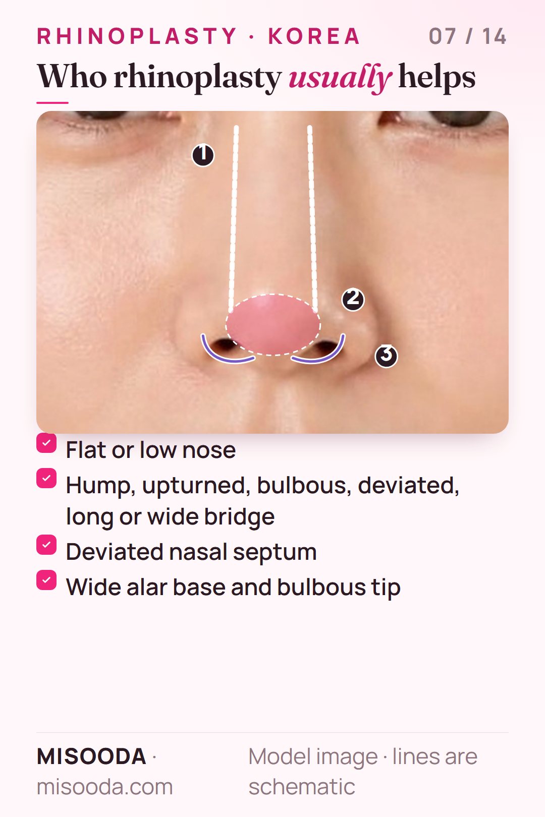 Rhinoplasty candidates: low nasal bridge, hump or bulbous tip, deviated septum, wide alar base, shown on a front view of the nose