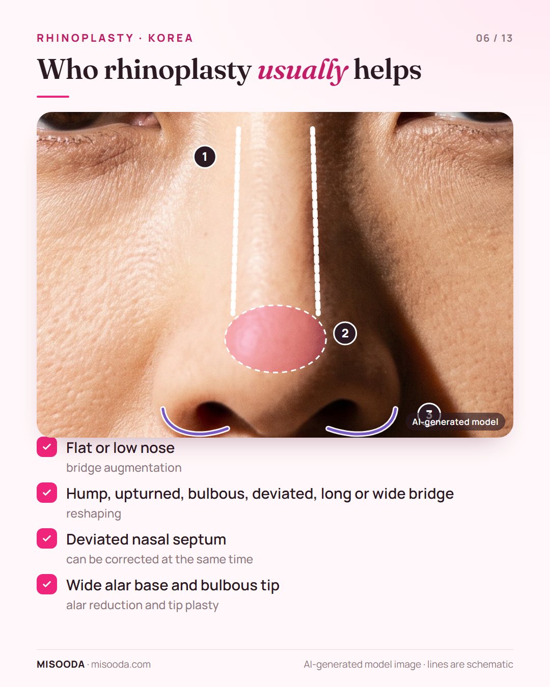 Rhinoplasty candidates: low nasal bridge, hump or bulbous tip, deviated septum, wide alar base, shown on a front view of the nose