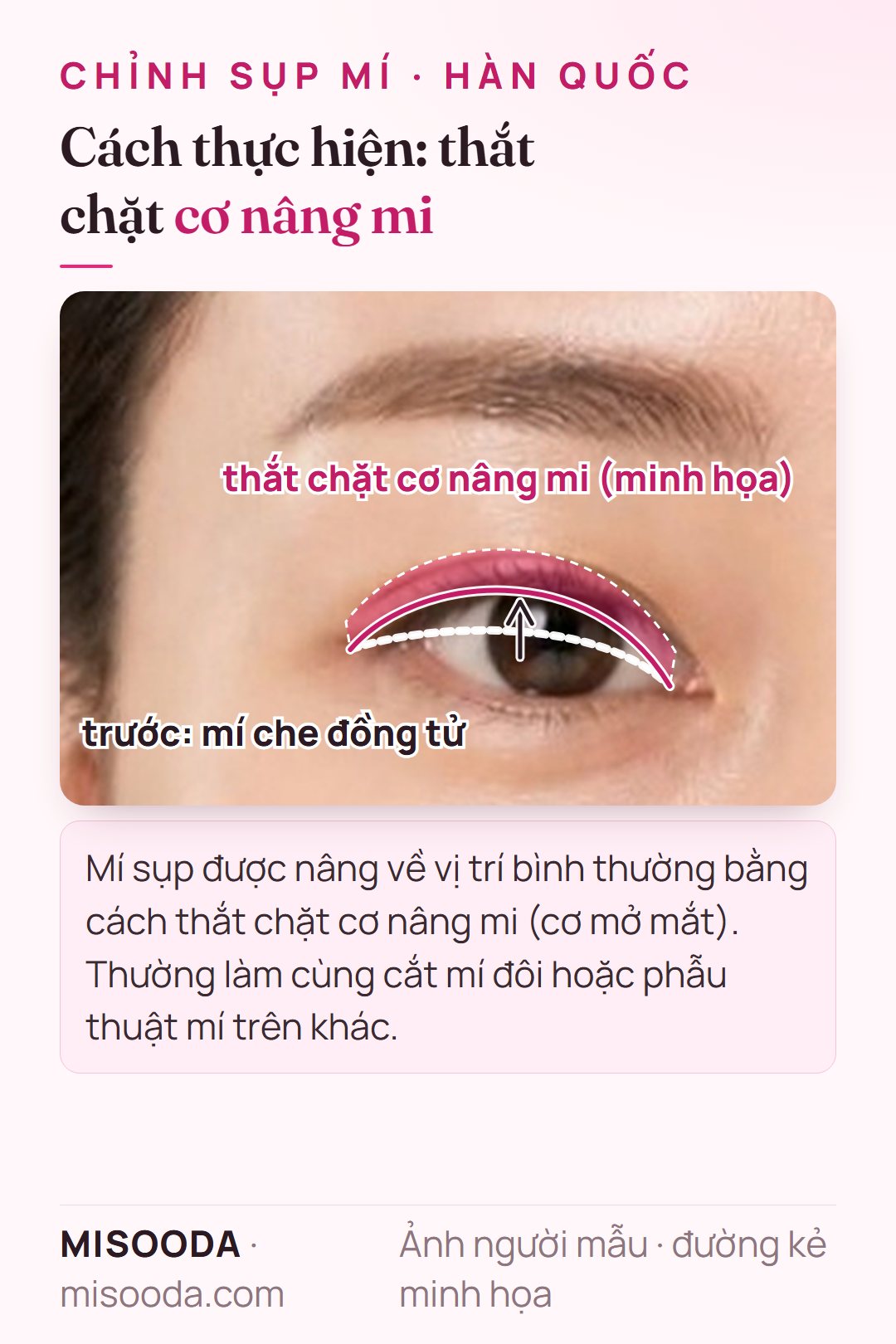 Chỉnh sụp mí nâng mí rủ về vị trí bình thường bằng cách thắt chặt cơ nâng mi (cơ mở mắt), minh họa trên một mắt