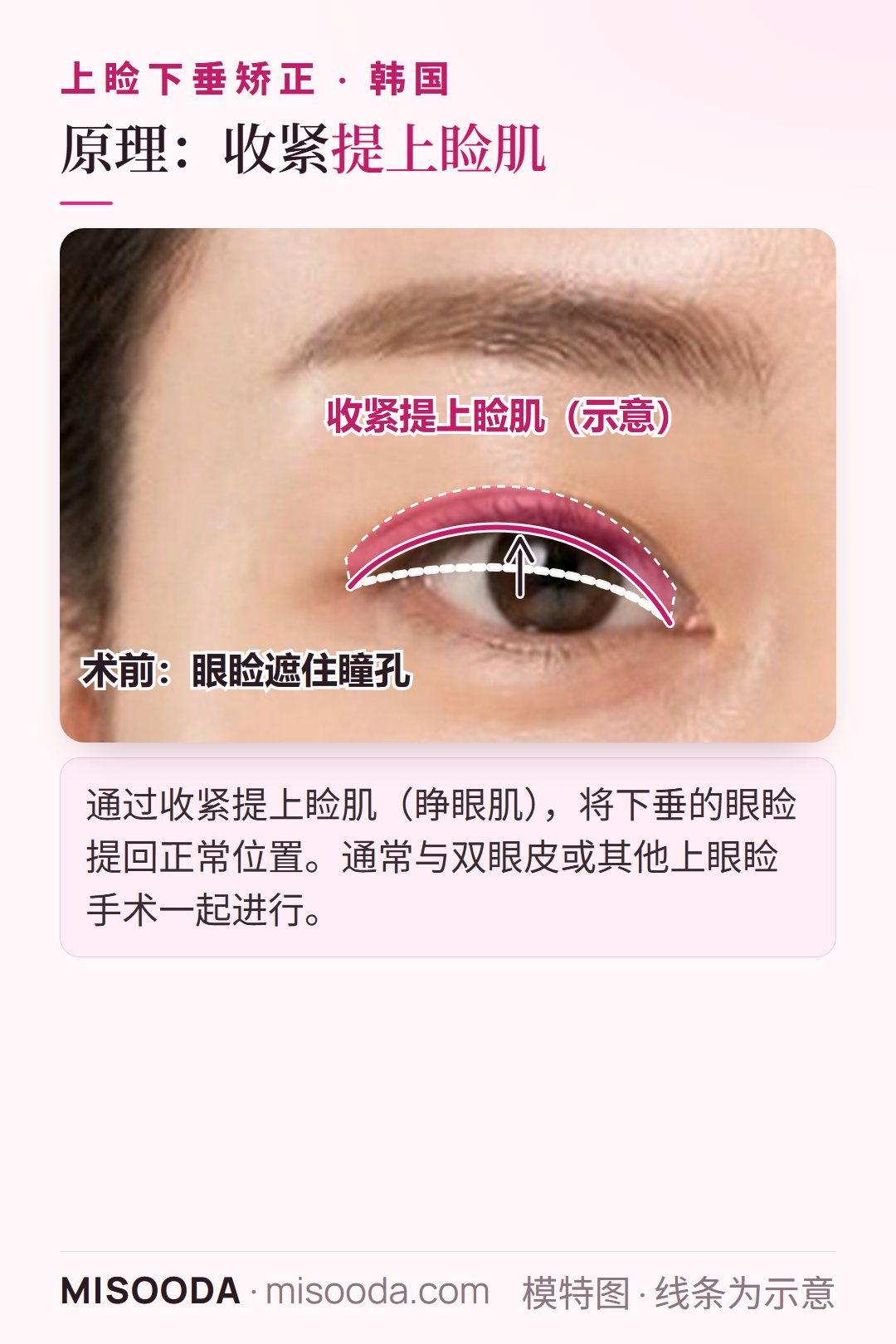 韩国 上睑下垂矫正通过收紧提上睑肌(睁眼肌),将下垂的眼睑提回正常位置,以单眼示意