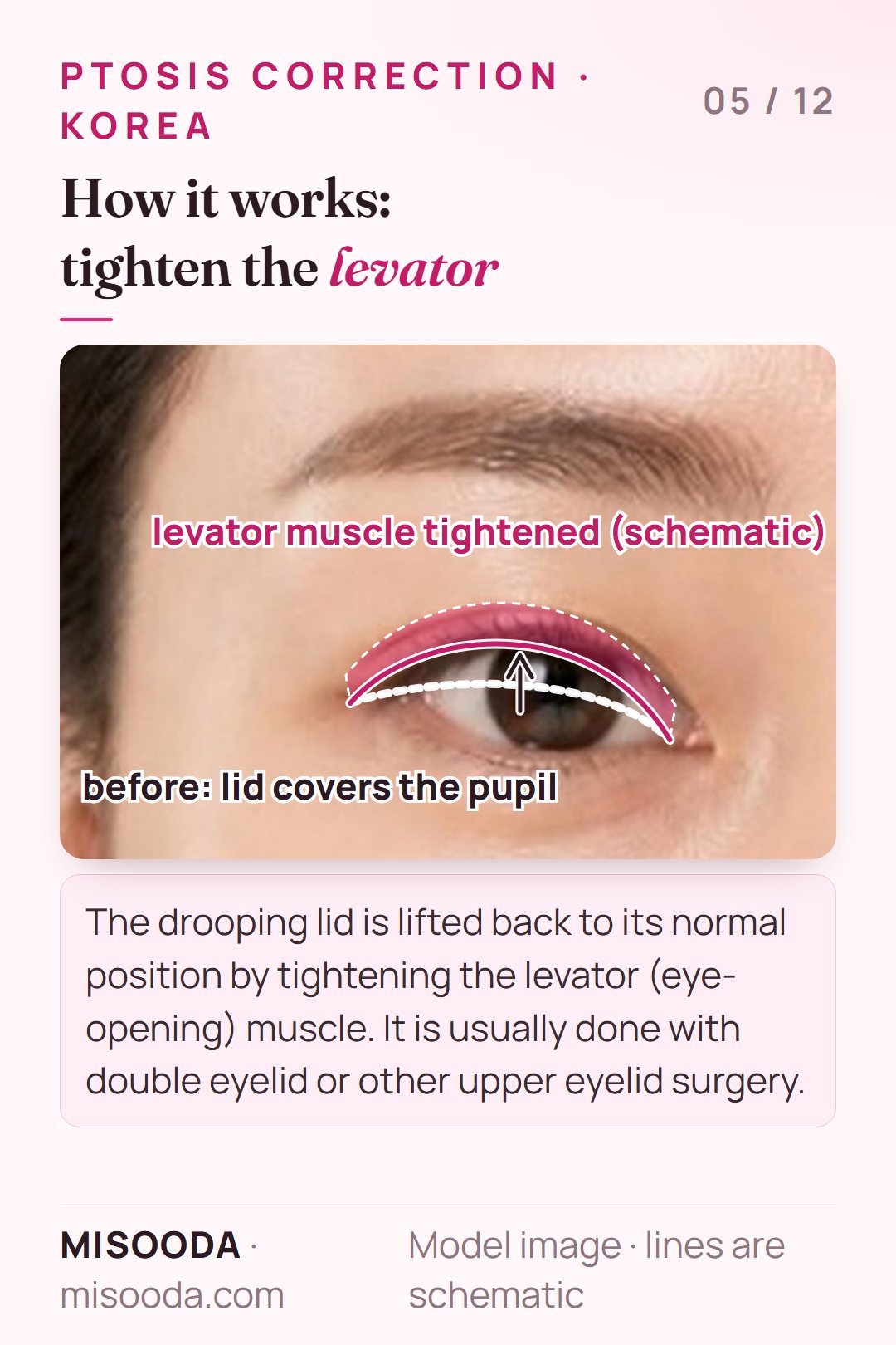 Ptosis correction lifts the drooping eyelid back to its normal position by tightening the levator (eye-opening) muscle, shown schematically on one eye