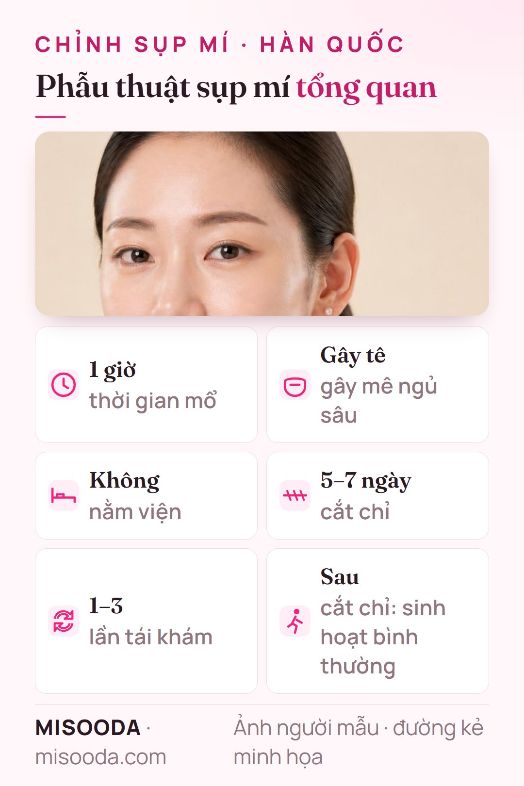 Thông tin phẫu thuật chỉnh sụp mí: khoảng 1 giờ dưới gây tê ngủ sâu, không nằm viện, cắt chỉ sau 5–7 ngày, 1–3 lần tái khám