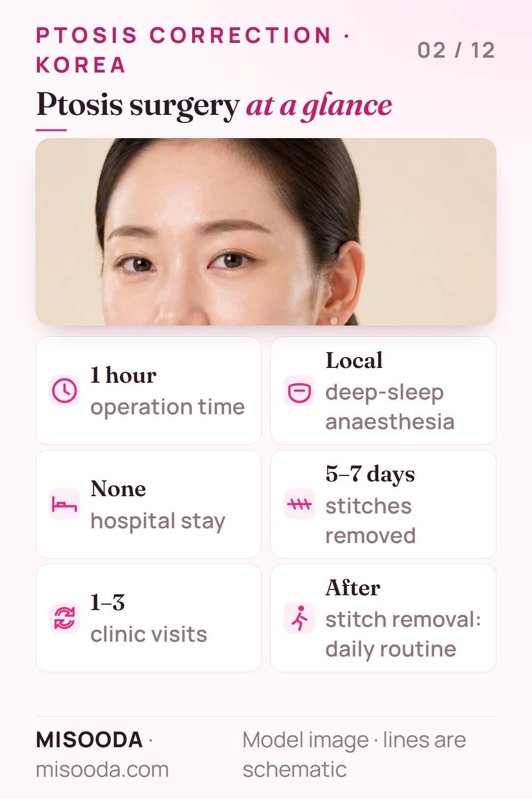 Ptosis correction surgery facts: about 1 hour under local deep-sleep anaesthesia, no hospital stay, stitches out in 5–7 days, 1–3 clinic visits