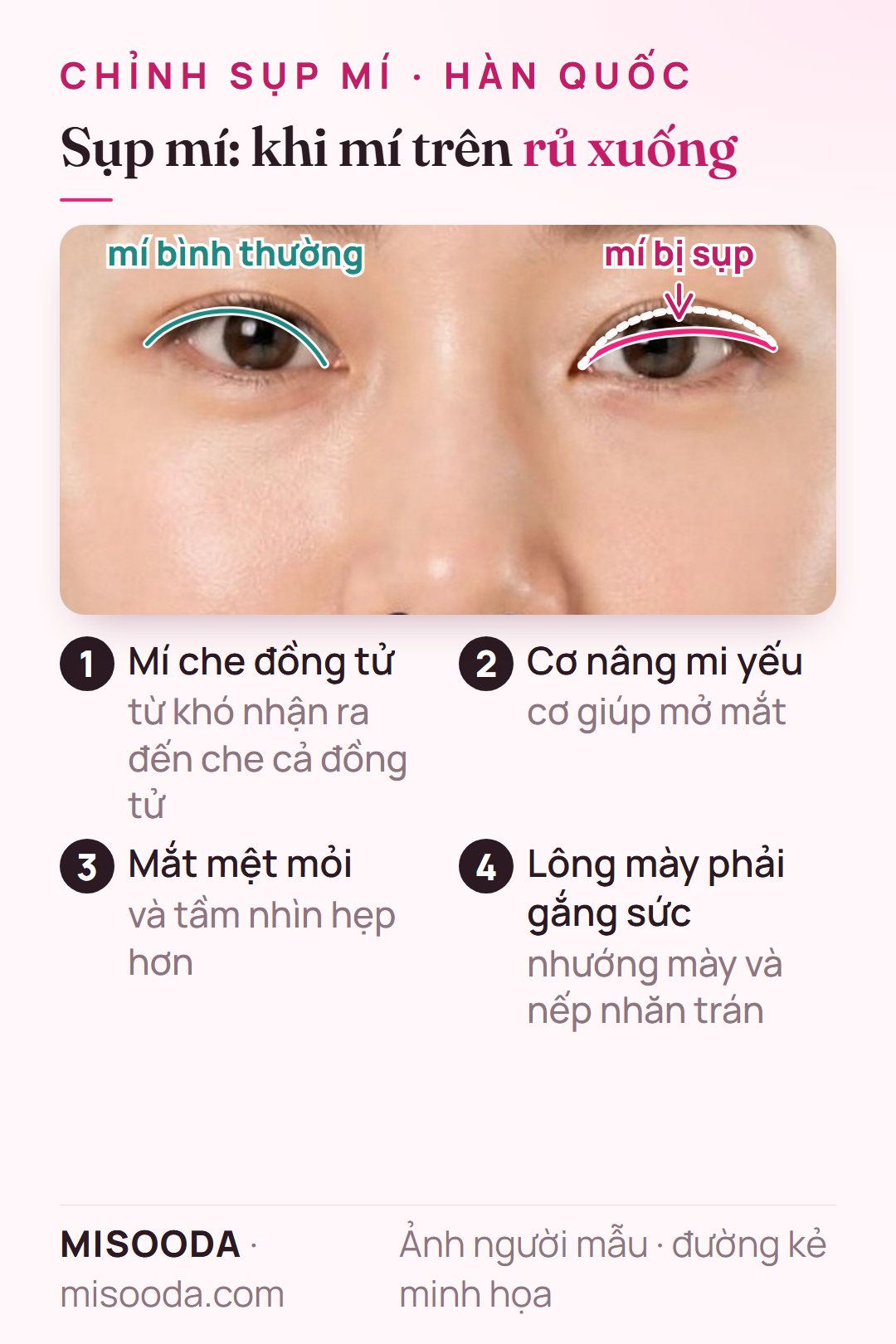 Sụp mí nhìn thẳng cả hai mắt: mí trên bình thường cạnh mí bị sụp che một phần đồng tử do cơ nâng mi yếu — chỉnh sụp mí Hàn Quốc