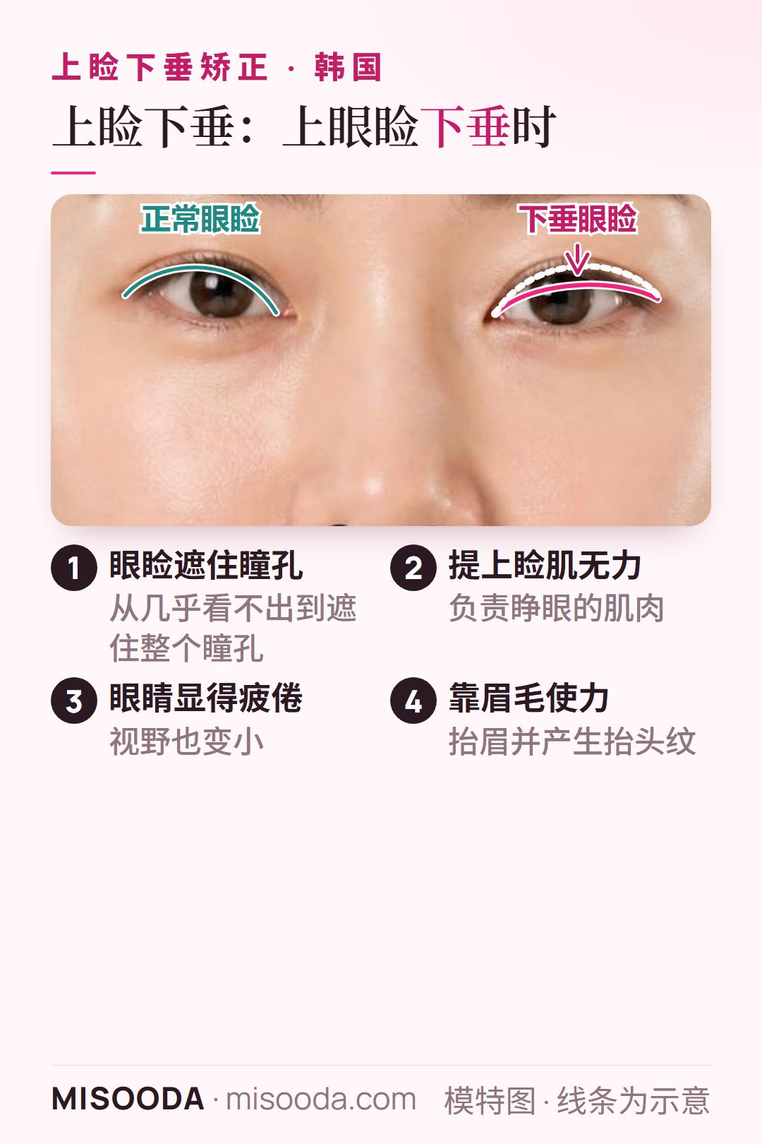 韩国 上睑下垂正面双眼示意:正常上眼睑旁边是遮住部分瞳孔的下垂眼睑,原因是提上睑肌无力