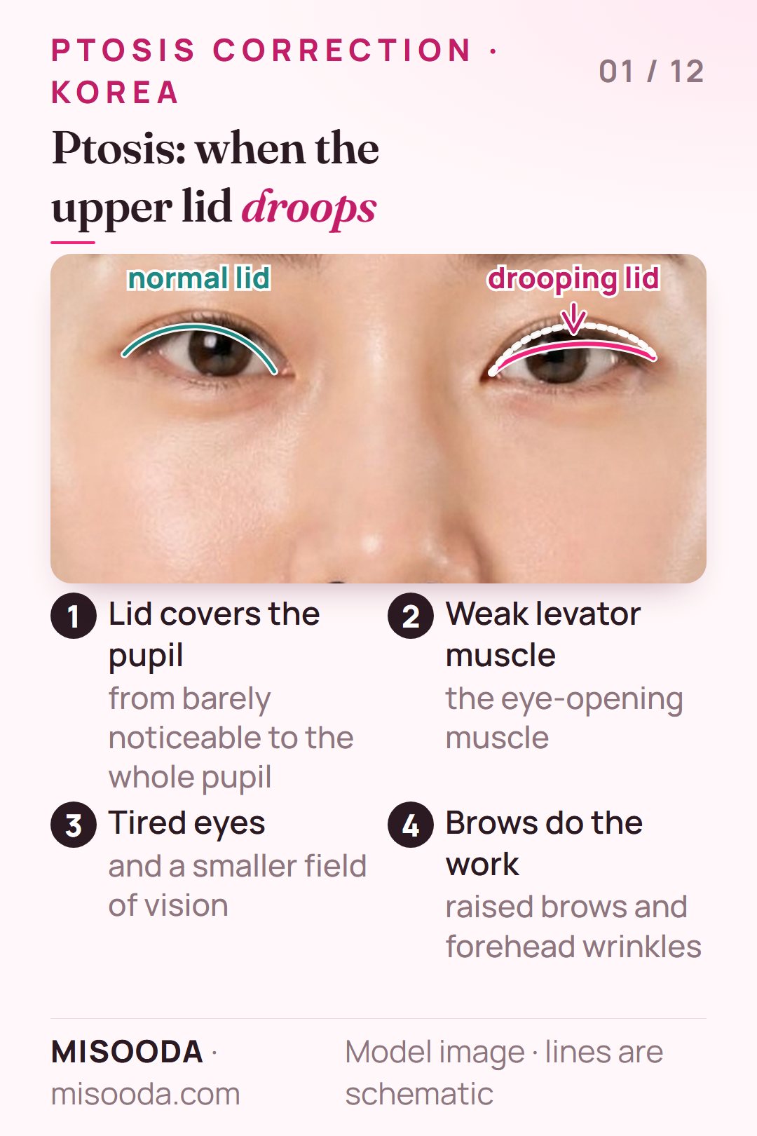 Ptosis on a front view of both eyes: a normal upper eyelid next to a drooping lid covering part of the pupil, caused by a weak levator muscle