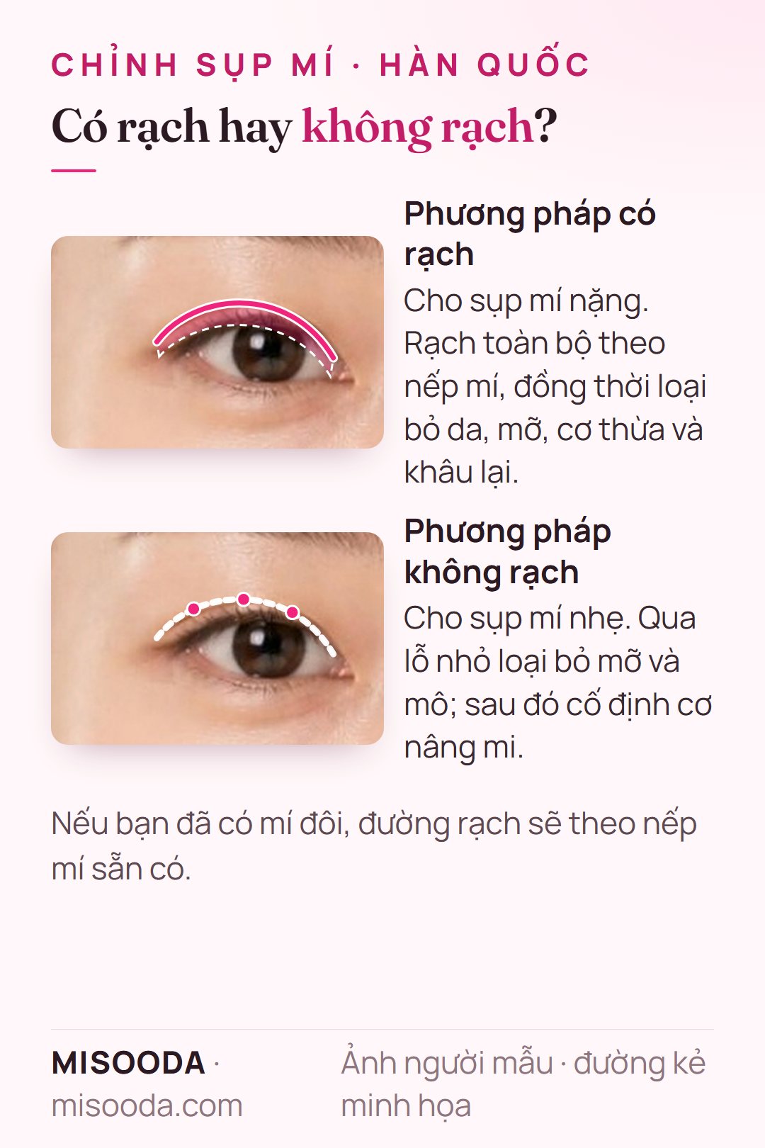 Phương pháp chỉnh sụp mí: rạch theo nếp mí cho sụp mí nặng vs lỗ nhỏ và cố định cơ nâng mi cho sụp mí nhẹ