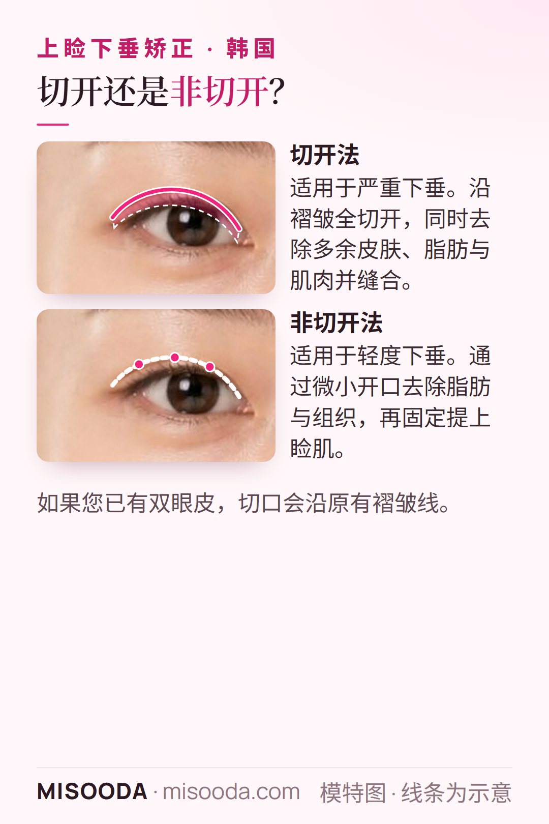 韩国 上睑下垂矫正的两种方法:重度下垂沿双眼皮褶皱切开,轻度下垂则通过微小开口去除组织并固定提上睑肌