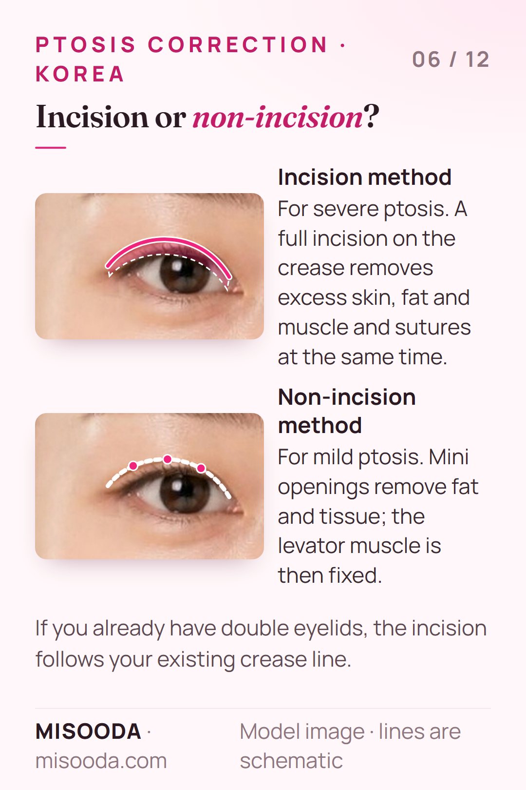 Ptosis correction methods on the eyelid: incision along the crease for severe ptosis vs mini openings and levator fixation for mild ptosis