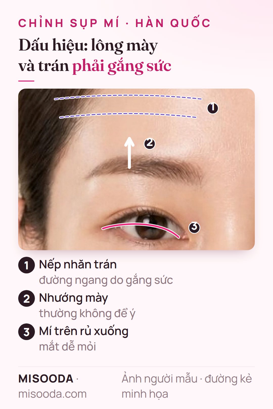 Dấu hiệu sụp mí: mí trên rủ xuống, vô thức nhướng mày để mở mắt và nếp nhăn ngang trên trán, minh họa nhìn thẳng
