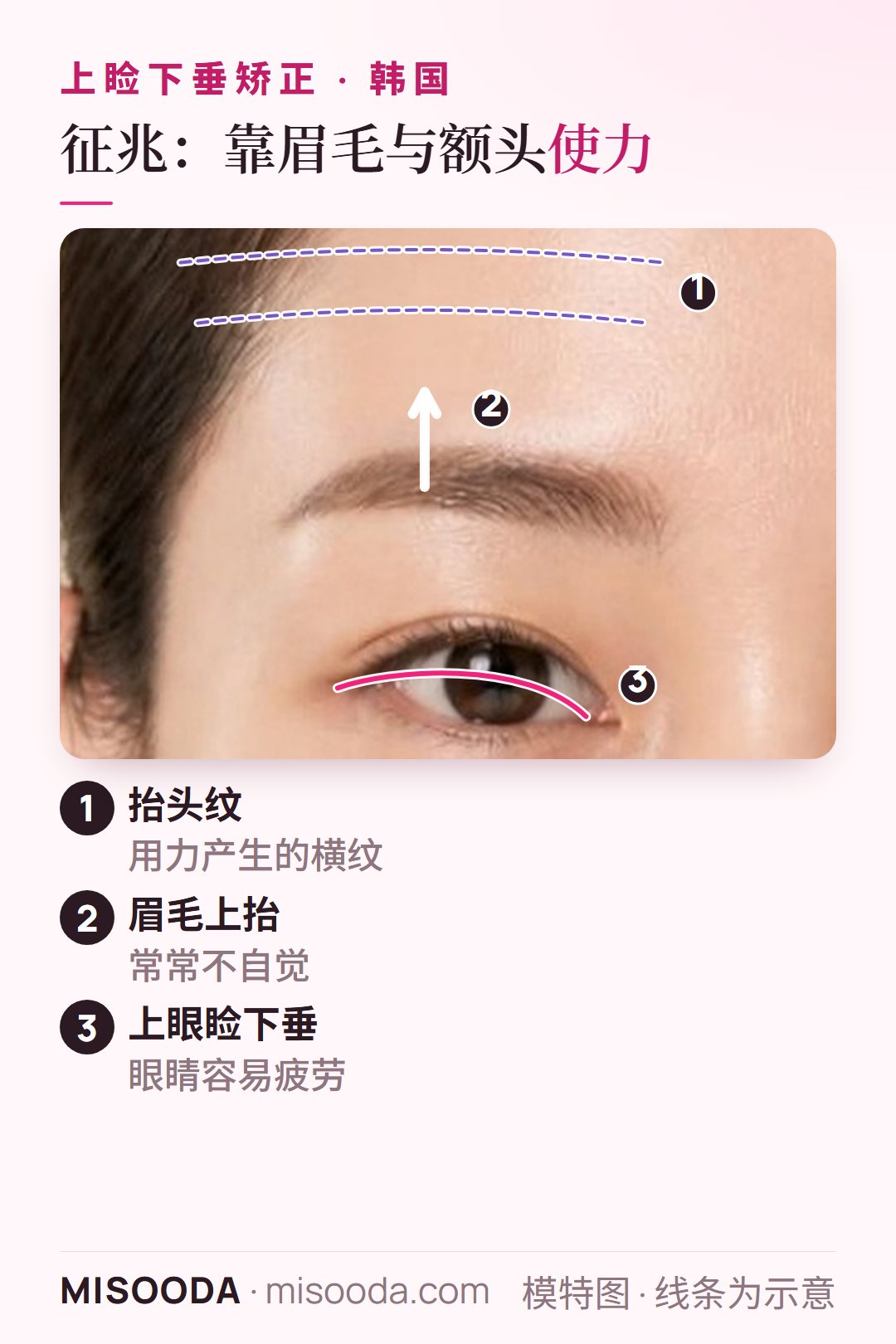 韩国 上睑下垂征兆:上眼睑下垂,为睁眼不自觉抬眉,额头出现横向抬头纹,以正面示意
