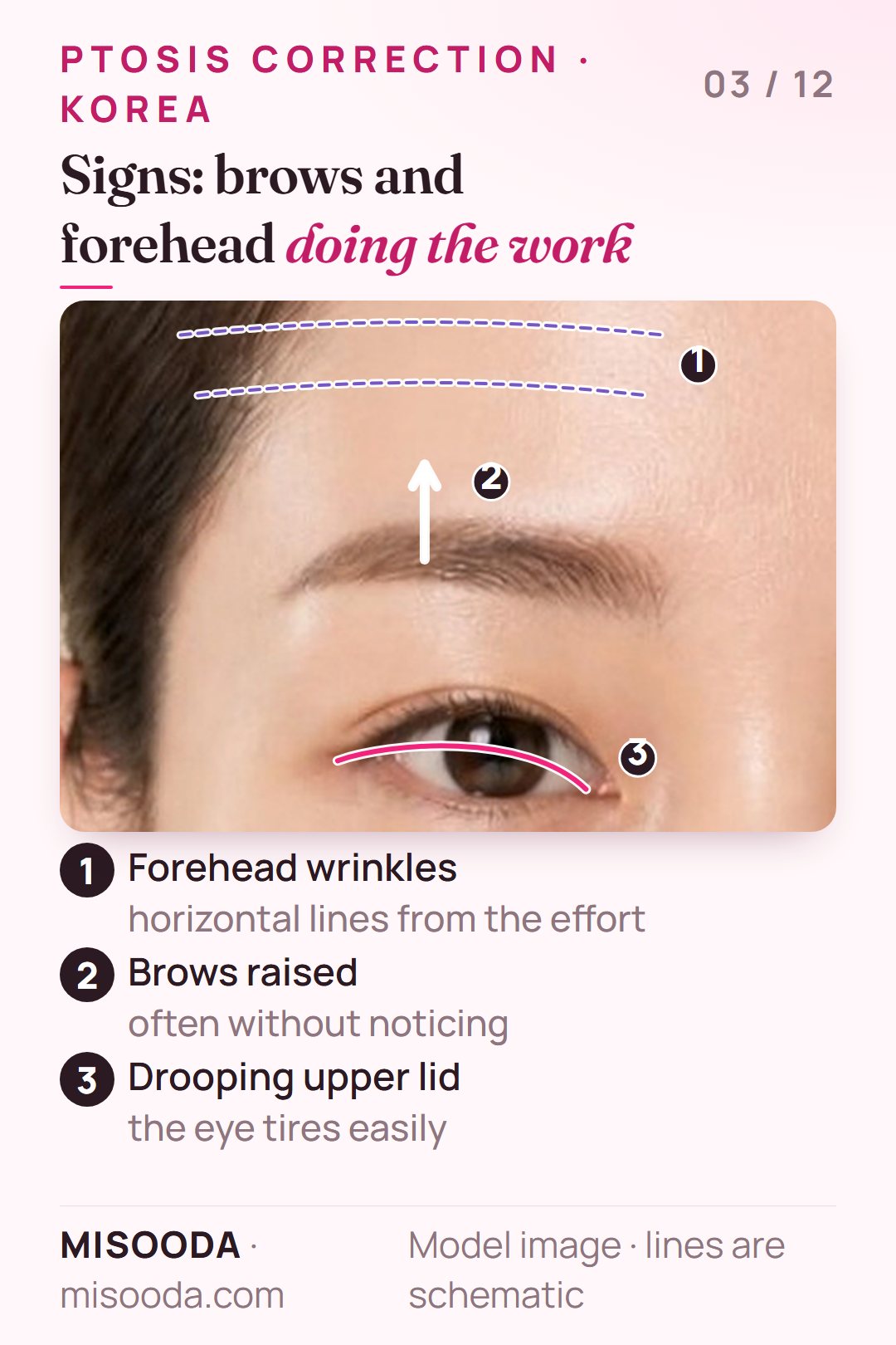 Signs of ptosis: drooping upper eyelid, eyebrows raised unconsciously to open the eyes and horizontal forehead wrinkles, shown on a front view
