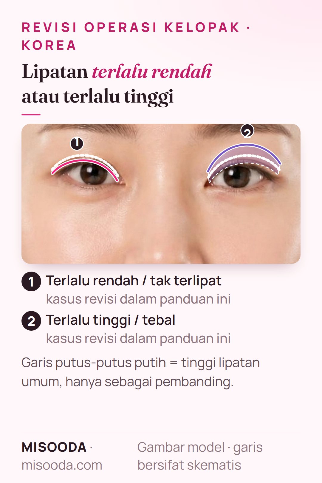 Kasus revisi kelopak ganda pada kedua mata: lipatan terlalu rendah atau tak terlipat di satu mata dan lipatan terlalu tinggi dan tebal di mata lain, garis skematis