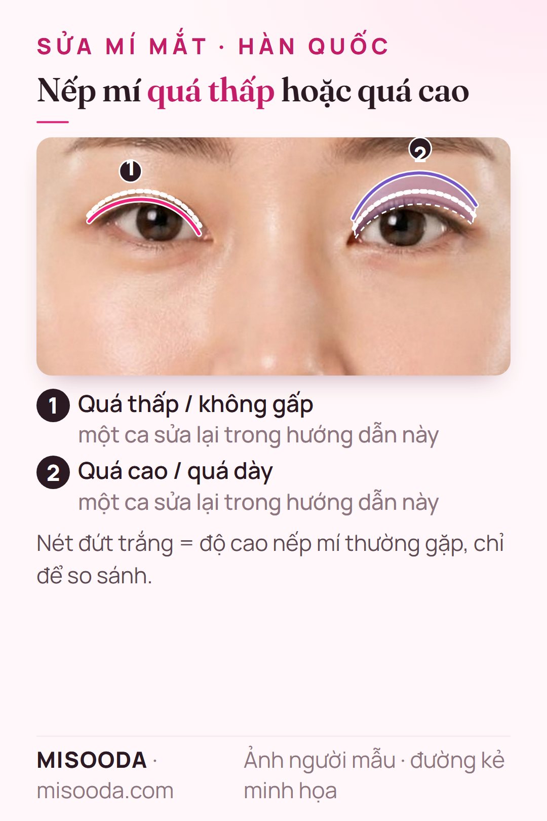 Ca sửa mí đôi trên hai mắt: một mắt nếp mí quá thấp hoặc không gấp, mắt kia nếp mí quá cao và dày, đường kẻ minh họa